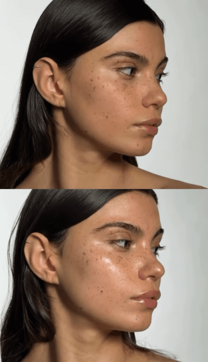 hydrafacial